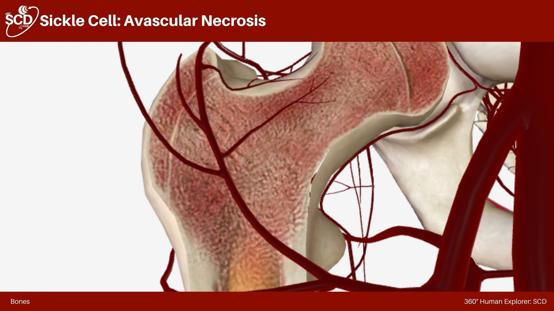 Sickle Cell: Avascular Necrosis – 360° SCD Hub